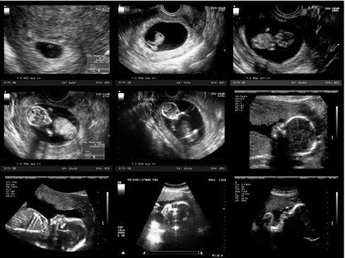 Interruption Médicale de Grossesse